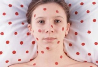 Корь в Европе, Украине и уже у нас. Как не заразиться?