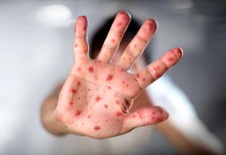 В Беларуси в 2019 году зарегистрировали два случая кори